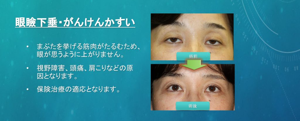 眼瞼下垂の術前術後写真